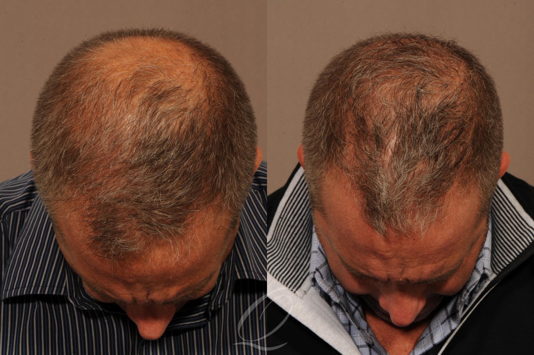 Male FUE Hair Transplant Before & After Photos Patient 1334 | Rochester,  Buffalo, & Syracuse, NY | Quatela Center for Hair Restoration