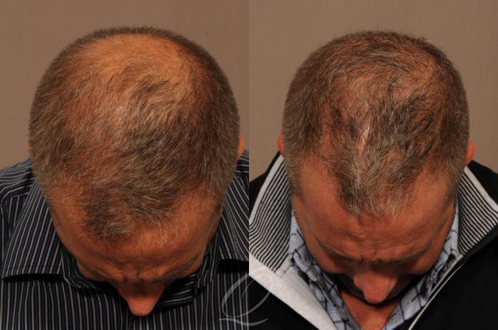 Male FUE Hair Transplant Case 1334 Before & After View #1 | Rochester, Buffalo, & Syracuse, NY | Quatela Center for Hair Restoration