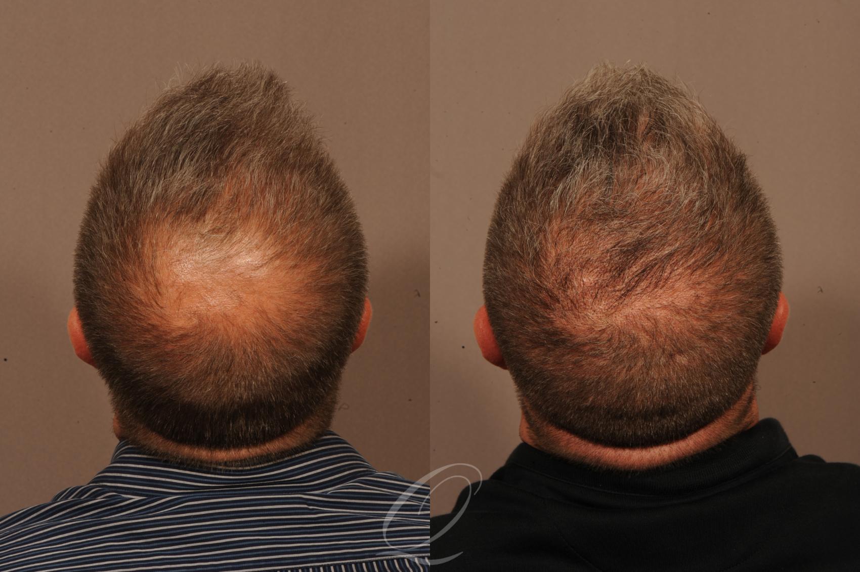 Male FUE Hair Transplant Case 1334 Before & After View #2 | Rochester, Buffalo, & Syracuse, NY | Quatela Center for Hair Restoration