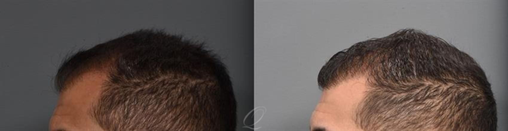 Male FUE Hair Transplant Case 389 Before & After Left Side | Rochester, Buffalo, & Syracuse, NY | Quatela Center for Hair Restoration