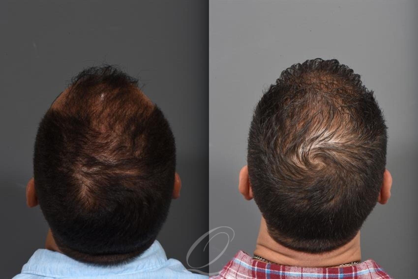 Male FUE Hair Transplant Case 389 Before & After Top Back | Rochester, Buffalo, & Syracuse, NY | Quatela Center for Hair Restoration