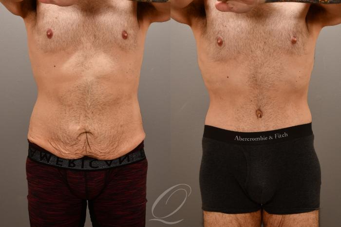 Male Tummy Tuck Case 1001911 Before & After Front | Serving Rochester, Syracuse & Buffalo, NY | Quatela Center for Plastic Surgery