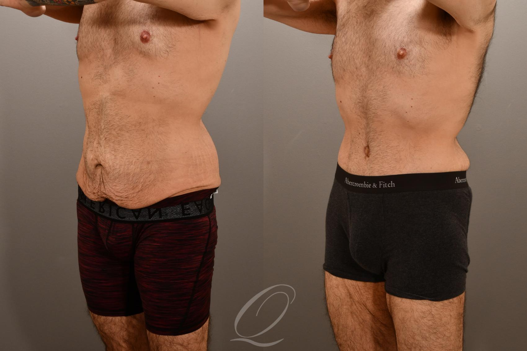 Male Tummy Tuck Case 1001911 Before & After Left Oblique | Serving Rochester, Syracuse & Buffalo, NY | Quatela Center for Plastic Surgery
