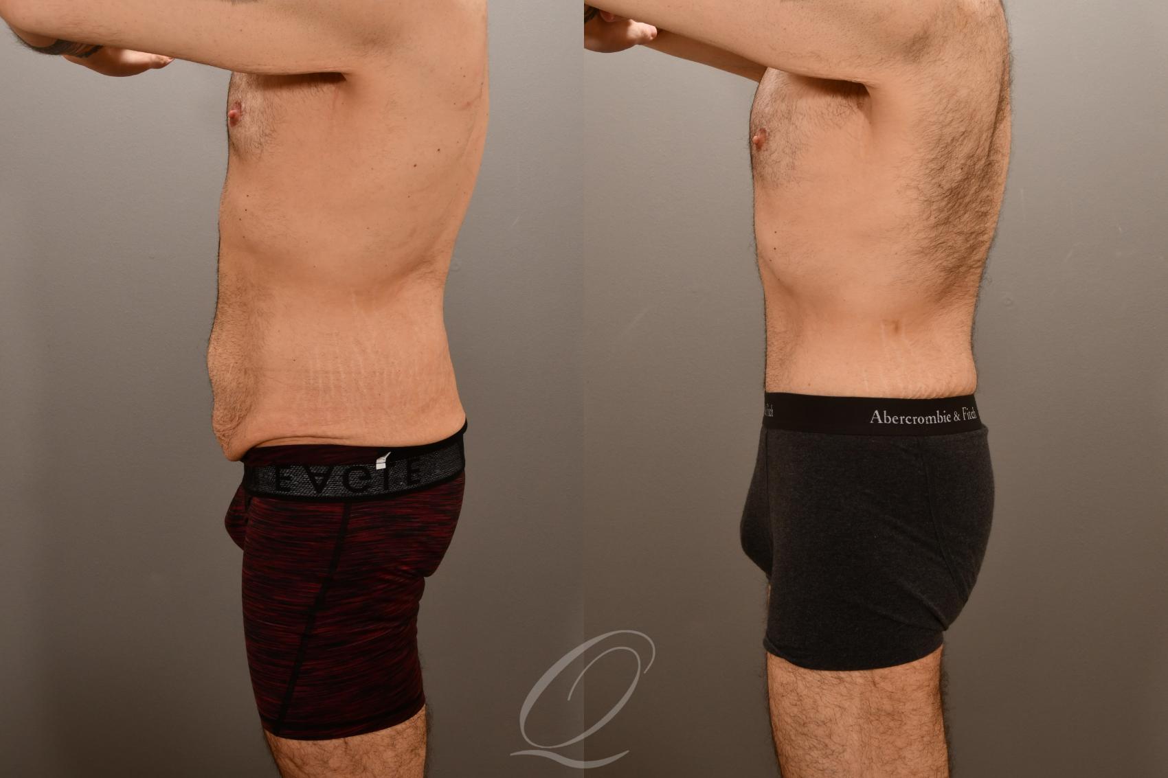 Male Tummy Tuck Case 1001911 Before & After Left Side | Serving Rochester, Syracuse & Buffalo, NY | Quatela Center for Plastic Surgery
