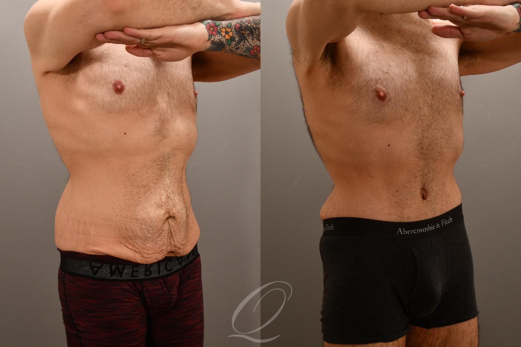 Male Tummy Tuck Case 1001911 Before & After Right Oblique | Serving Rochester, Syracuse & Buffalo, NY | Quatela Center for Plastic Surgery