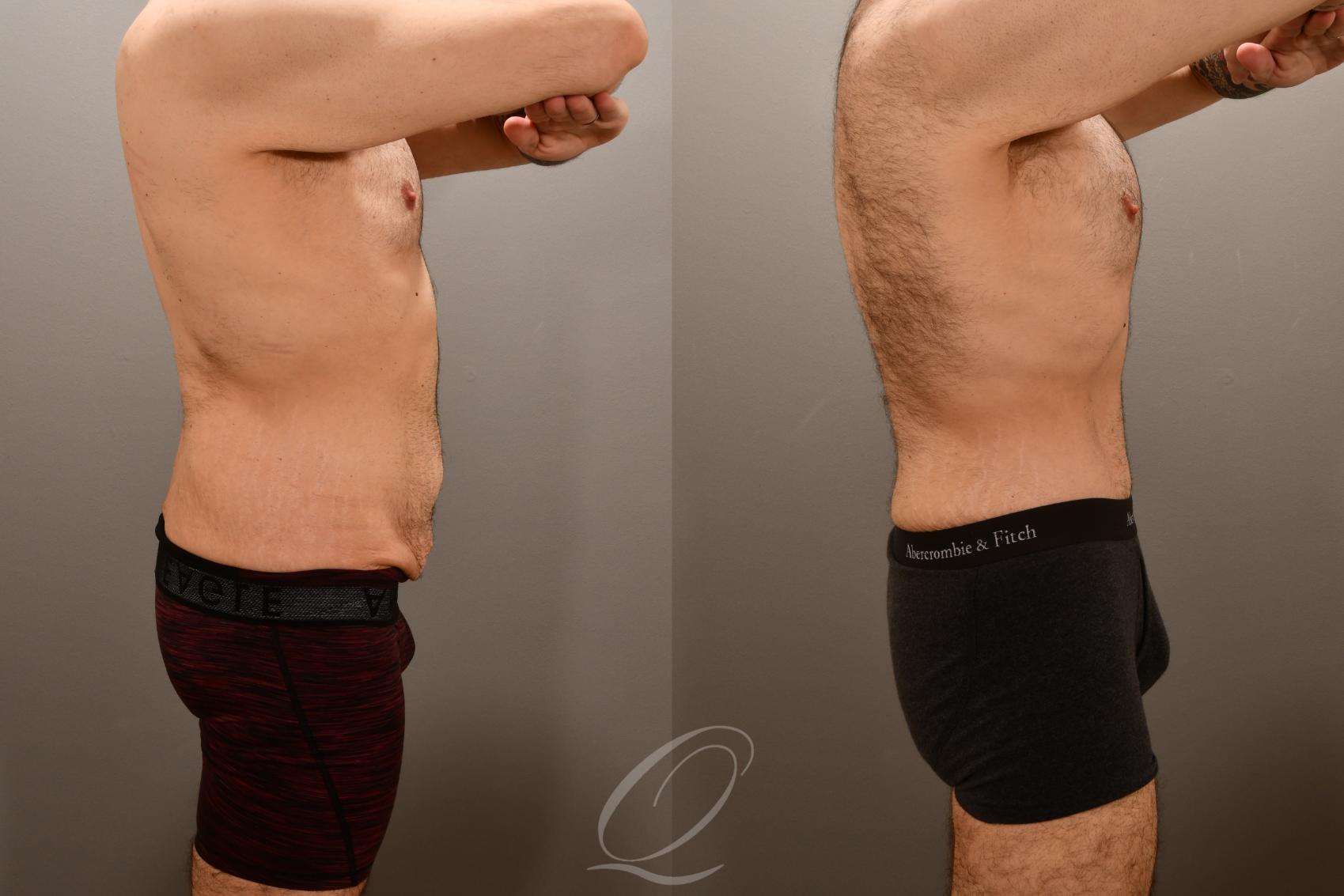Male Tummy Tuck Case 1001911 Before & After Right Side | Serving Rochester, Syracuse & Buffalo, NY | Quatela Center for Plastic Surgery