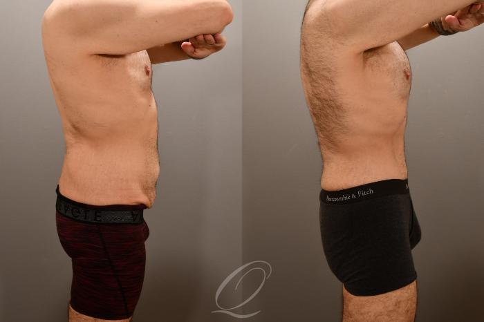 Male Tummy Tuck Case 1001911 Before & After Right Side | Serving Rochester, Syracuse & Buffalo, NY | Quatela Center for Plastic Surgery