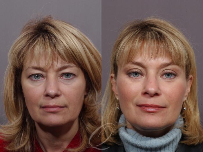 Mid Facelift Case 168 Before & After View #1 | Serving Rochester, Syracuse & Buffalo, NY | Quatela Center for Plastic Surgery