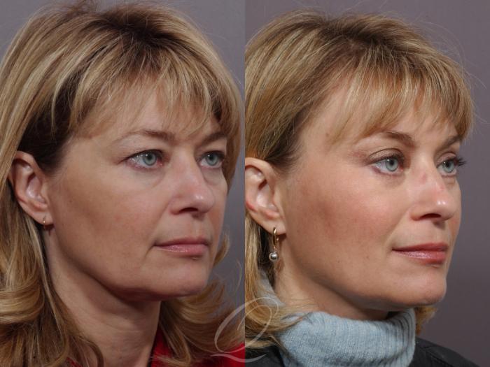 Mid Facelift Case 168 Before & After View #2 | Serving Rochester, Syracuse & Buffalo, NY | Quatela Center for Plastic Surgery
