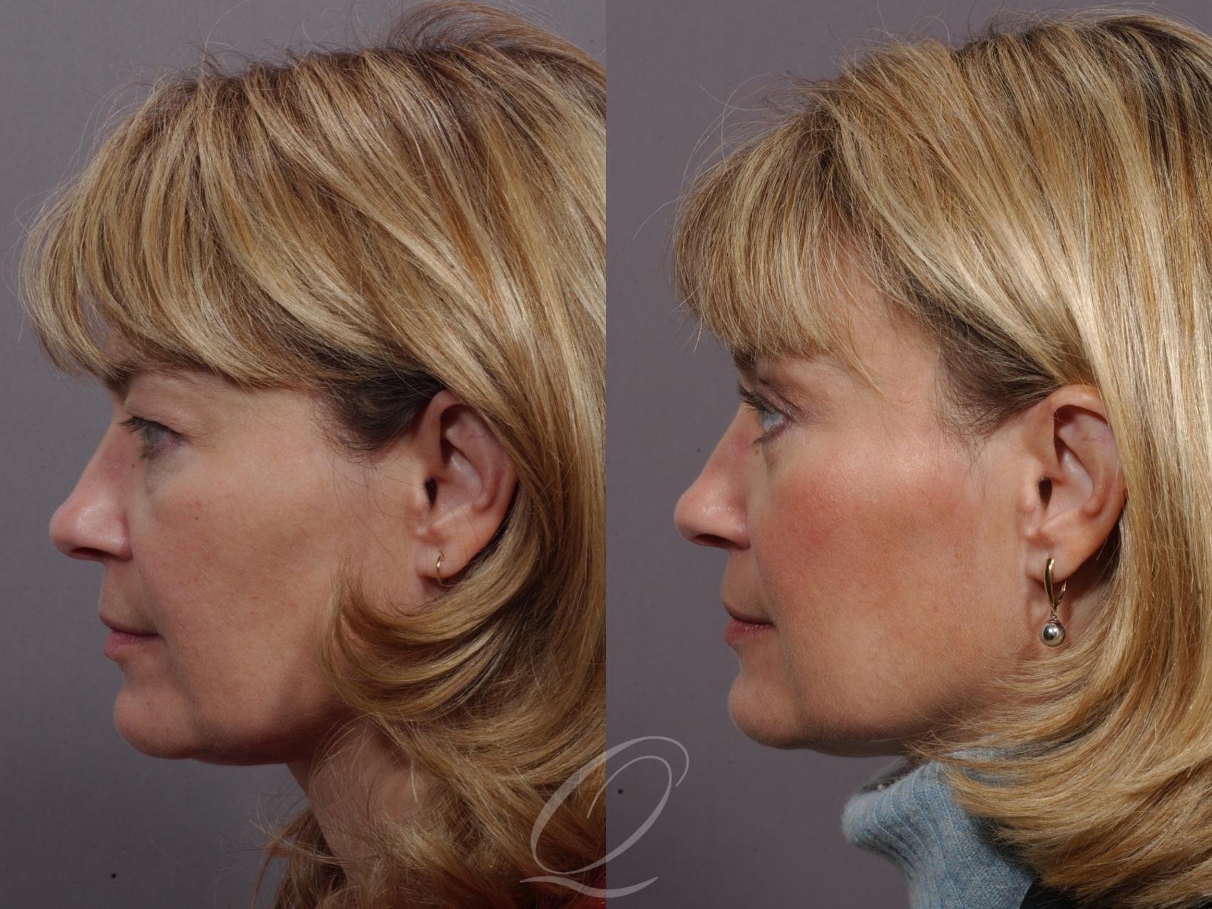 Mid Facelift Case 168 Before & After View #3 | Serving Rochester, Syracuse & Buffalo, NY | Quatela Center for Plastic Surgery