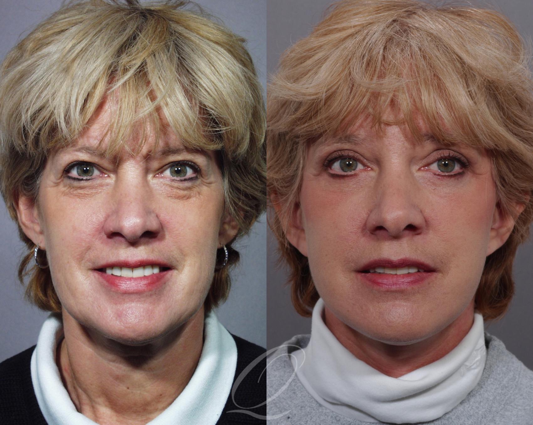 Mid Facelift Case 197 Before & After View #1 | Serving Rochester, Syracuse & Buffalo, NY | Quatela Center for Plastic Surgery