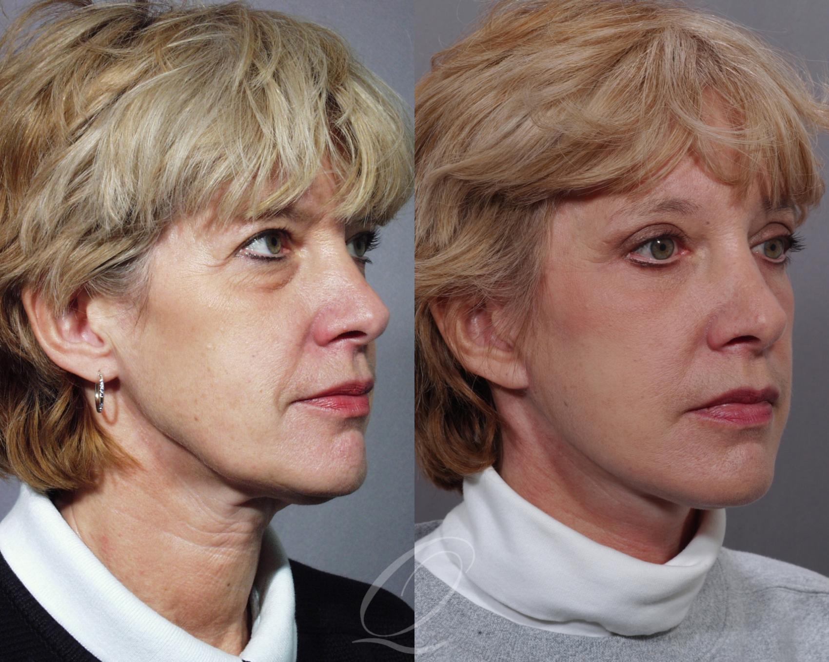 Mid Facelift Case 197 Before & After View #2 | Serving Rochester, Syracuse & Buffalo, NY | Quatela Center for Plastic Surgery