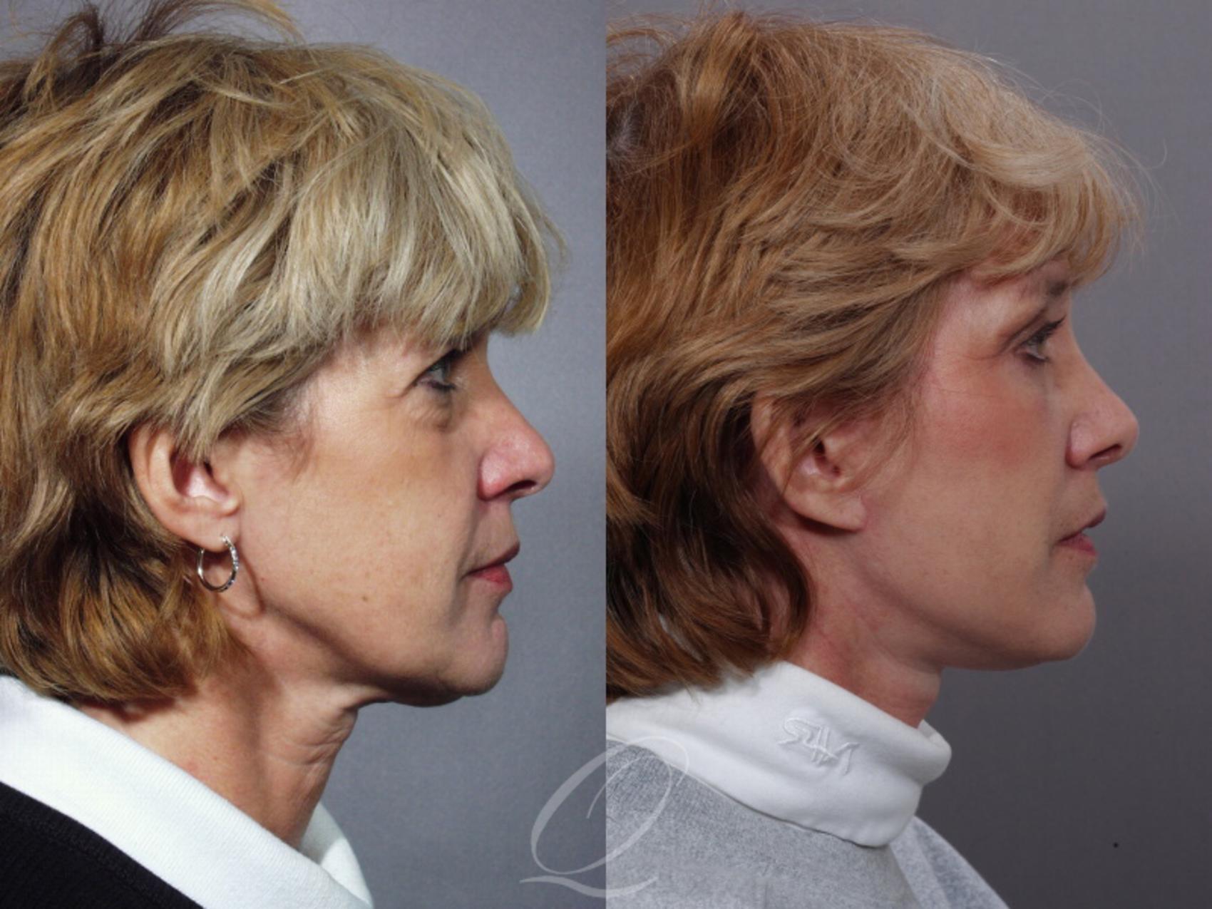 Mid Facelift Case 197 Before & After View #3 | Serving Rochester, Syracuse & Buffalo, NY | Quatela Center for Plastic Surgery