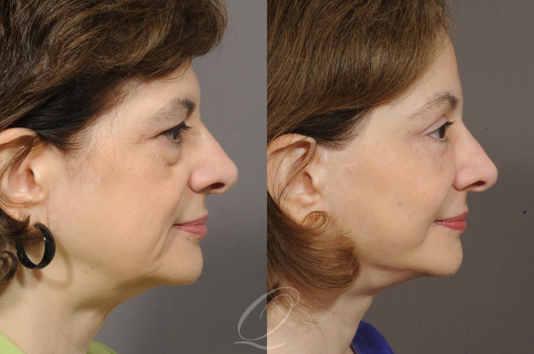 Mid Facelift Case 198 Before & After View #3 | Serving Rochester, Syracuse & Buffalo, NY | Quatela Center for Plastic Surgery