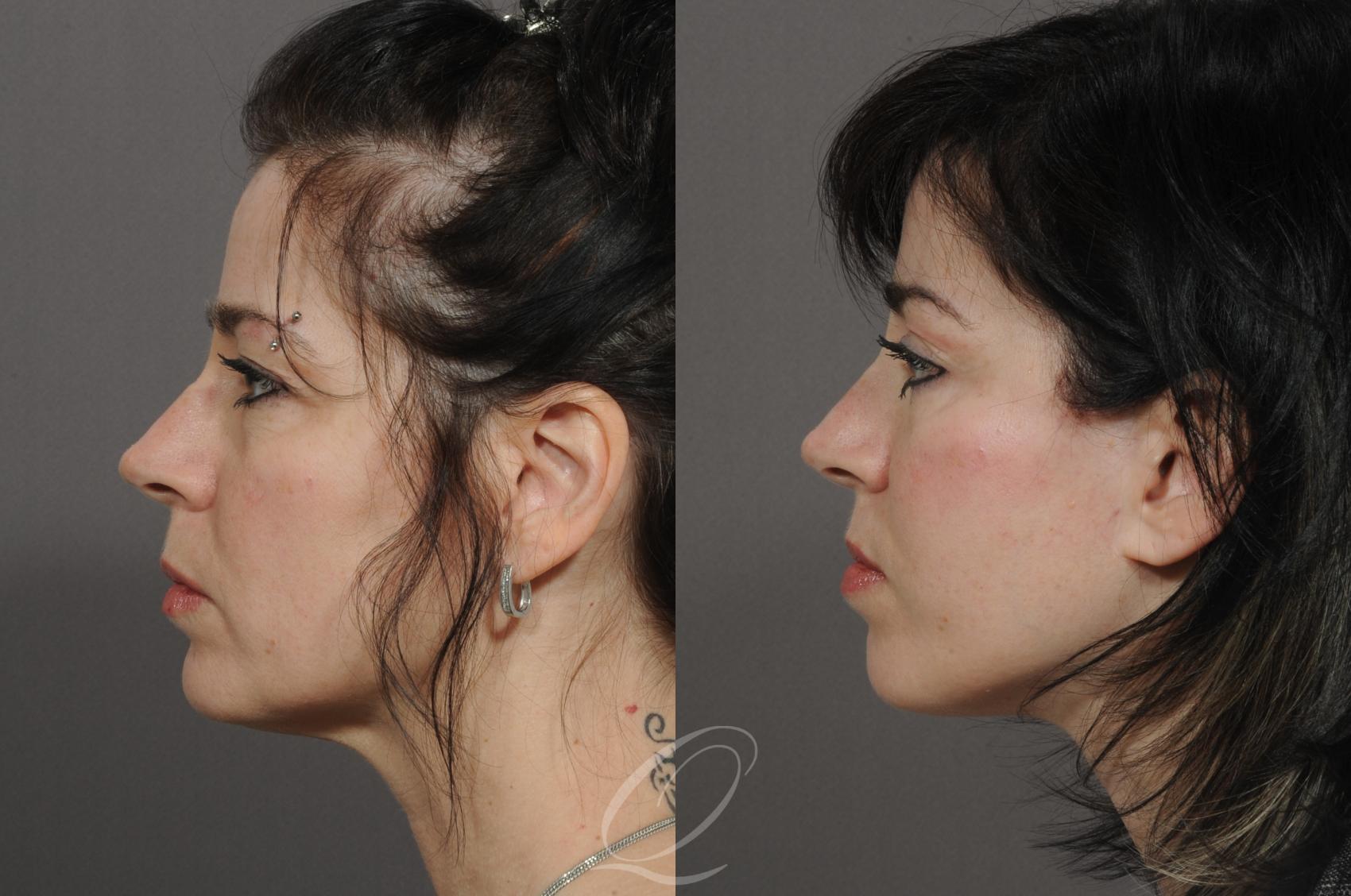 Mid Facelift Case 76 Before & After View #3 | Serving Rochester, Syracuse & Buffalo, NY | Quatela Center for Plastic Surgery