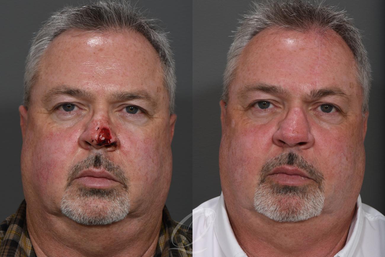 Mohs Reconstruction Case 1437 Before & After Front | Serving Rochester, Syracuse & Buffalo, NY | Quatela Center for Plastic Surgery