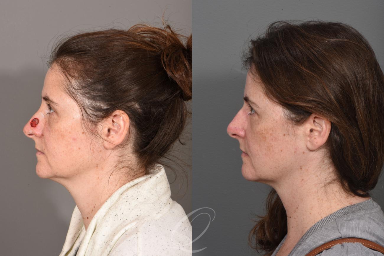 Mohs Reconstruction Case 1441 Before & After Left Side | Serving Rochester, Syracuse & Buffalo, NY | Quatela Center for Plastic Surgery