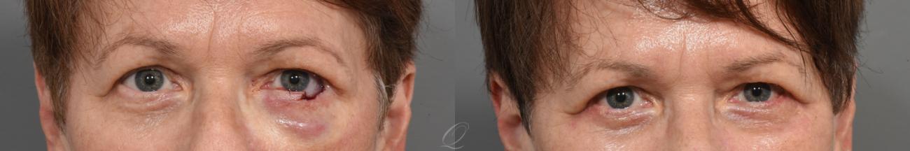 Mohs Reconstruction Case 1442 Before & After Front Close-Up | Serving Rochester, Syracuse & Buffalo, NY | Quatela Center for Plastic Surgery