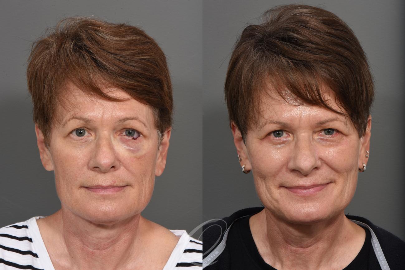 Mohs Reconstruction Case 1442 Before & After Front | Serving Rochester, Syracuse & Buffalo, NY | Quatela Center for Plastic Surgery