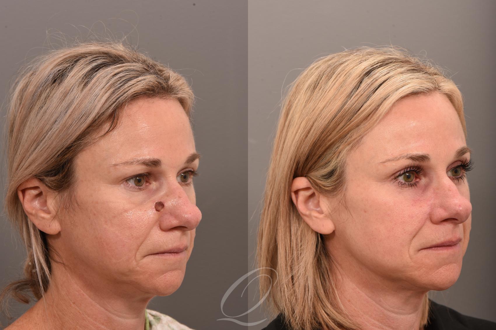 Mohs Reconstruction Case 1001734 Before & After Right Oblique | Serving Rochester, Syracuse & Buffalo, NY | Quatela Center for Plastic Surgery