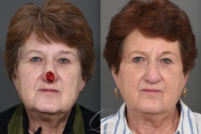 Mohs Reconstruction Case 1001743 Before & After Front | Serving Rochester, Syracuse & Buffalo, NY | Quatela Center for Plastic Surgery