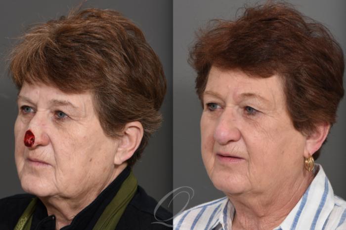Mohs Reconstruction Case 1001743 Before & After Left Oblique | Serving Rochester, Syracuse & Buffalo, NY | Quatela Center for Plastic Surgery