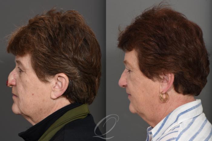 Mohs Reconstruction Case 1001743 Before & After Left Side | Serving Rochester, Syracuse & Buffalo, NY | Quatela Center for Plastic Surgery