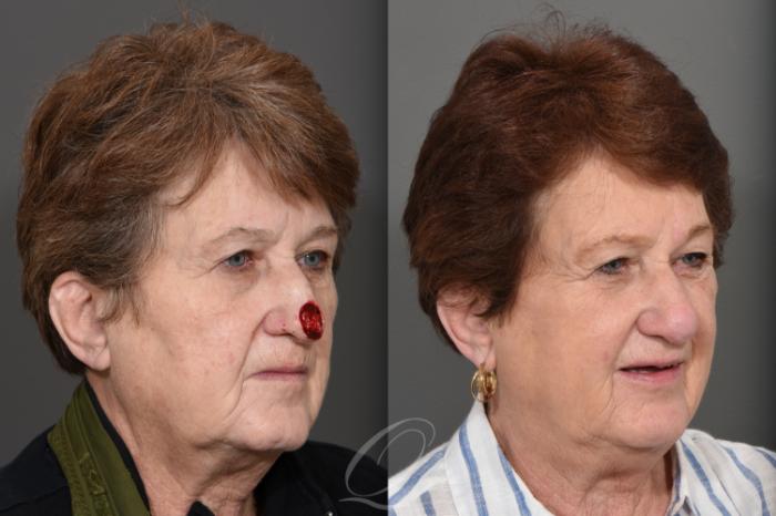 Mohs Reconstruction Case 1001743 Before & After Right Oblique | Serving Rochester, Syracuse & Buffalo, NY | Quatela Center for Plastic Surgery