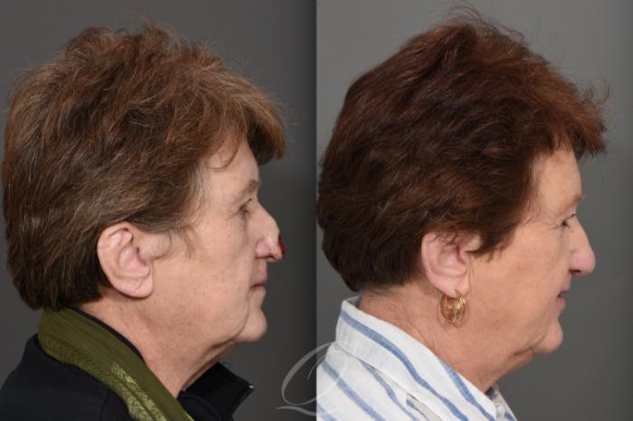 Mohs Reconstruction Case 1001743 Before & After Right Side | Serving Rochester, Syracuse & Buffalo, NY | Quatela Center for Plastic Surgery