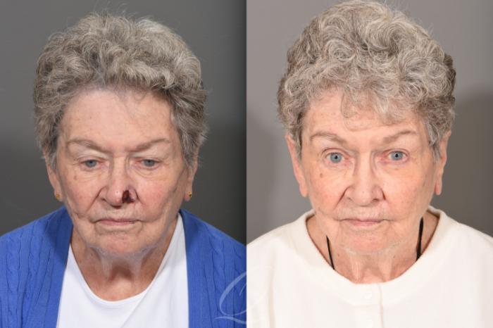 Mohs Reconstruction Case 1001744 Before & After Front | Serving Rochester, Syracuse & Buffalo, NY | Quatela Center for Plastic Surgery