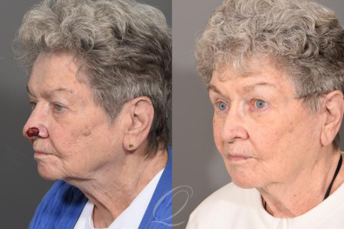 Mohs Reconstruction Case 1001744 Before & After Left Oblique | Serving Rochester, Syracuse & Buffalo, NY | Quatela Center for Plastic Surgery