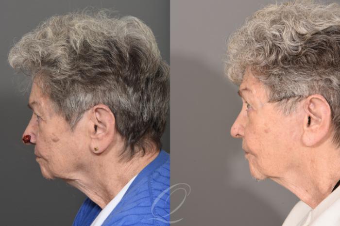 Mohs Reconstruction Case 1001744 Before & After Left Side | Serving Rochester, Syracuse & Buffalo, NY | Quatela Center for Plastic Surgery