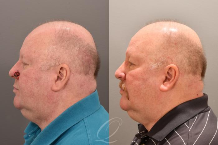 Mohs Reconstruction Case 1001754 Before & After Left Side | Serving Rochester, Syracuse & Buffalo, NY | Quatela Center for Plastic Surgery