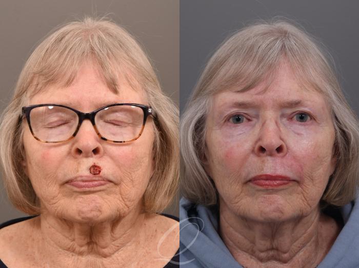 Mohs Reconstruction Case 1001962 Before & After Front | Serving Rochester, Syracuse & Buffalo, NY | Quatela Center for Plastic Surgery