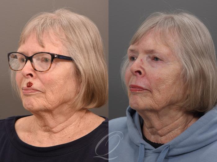 Mohs Reconstruction Case 1001962 Before & After Left Oblique | Serving Rochester, Syracuse & Buffalo, NY | Quatela Center for Plastic Surgery