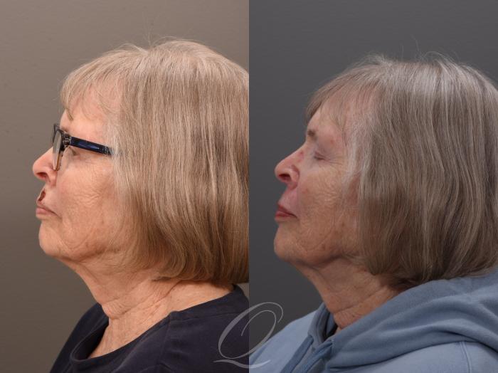 Mohs Reconstruction Case 1001962 Before & After Left Side | Serving Rochester, Syracuse & Buffalo, NY | Quatela Center for Plastic Surgery