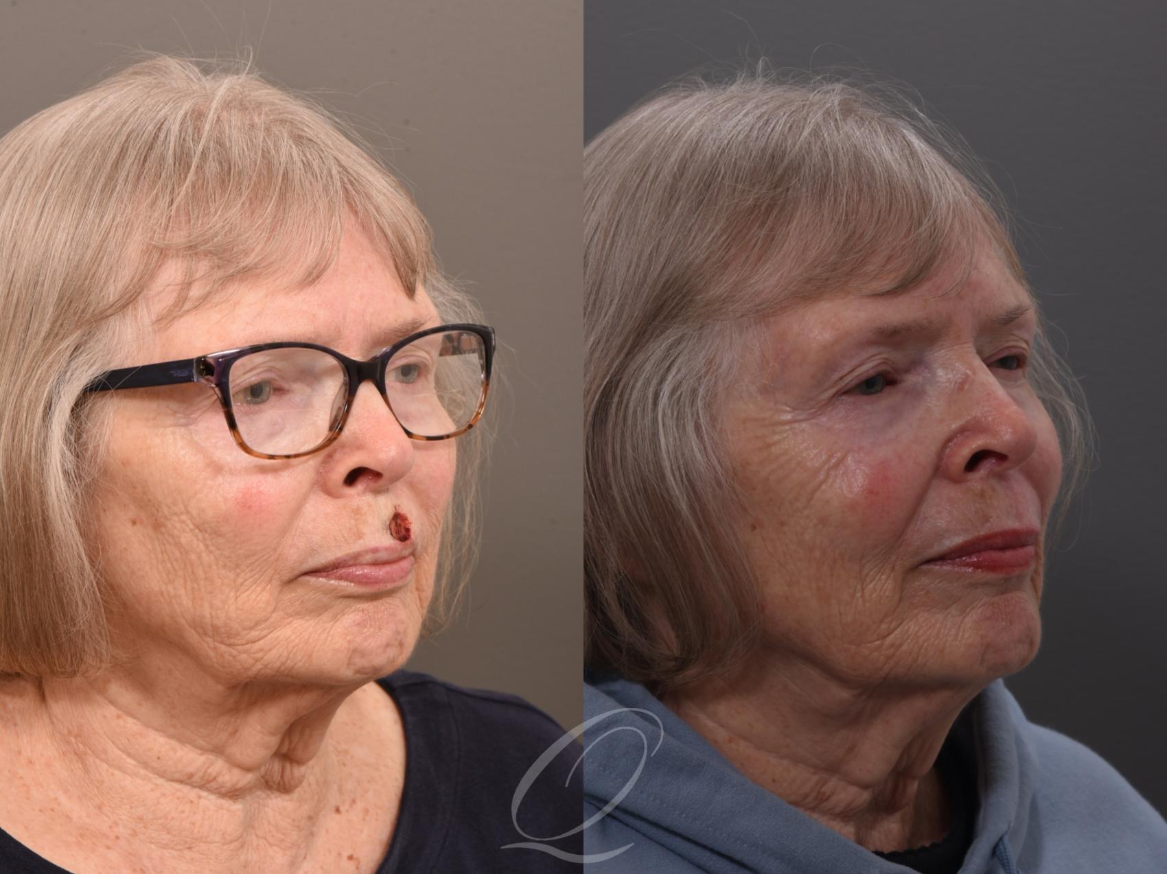 Mohs Reconstruction Case 1001962 Before & After Right Oblique | Serving Rochester, Syracuse & Buffalo, NY | Quatela Center for Plastic Surgery