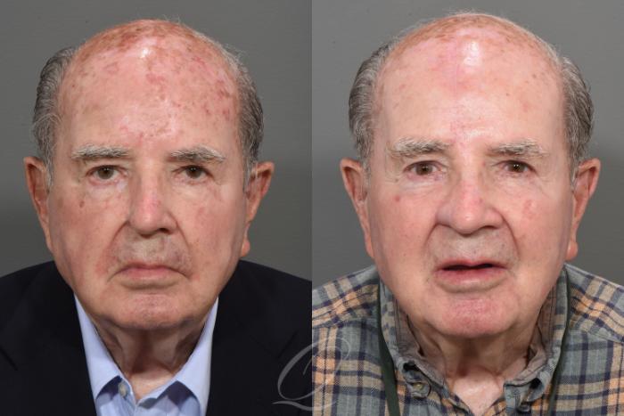 Mohs Reconstruction Case 1527 Before & After Front | Serving Rochester, Syracuse & Buffalo, NY | Quatela Center for Plastic Surgery