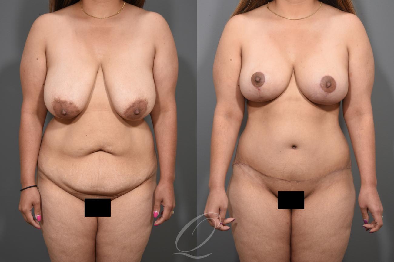 Mommy Makeover Case 1001259 Before & After View #1 | Serving Rochester, Syracuse & Buffalo, NY | Quatela Center for Plastic Surgery