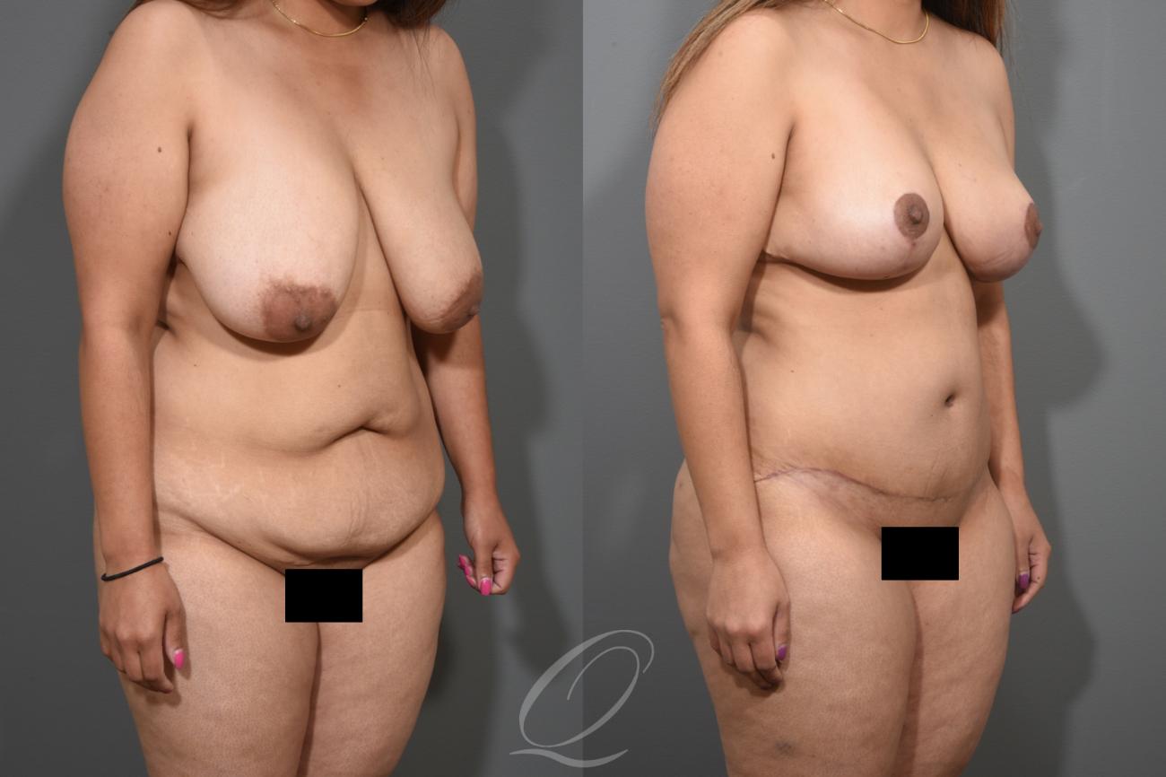 Breast Lift Case 1001259 Before & After View #2 | Serving Rochester, Syracuse & Buffalo, NY | Quatela Center for Plastic Surgery