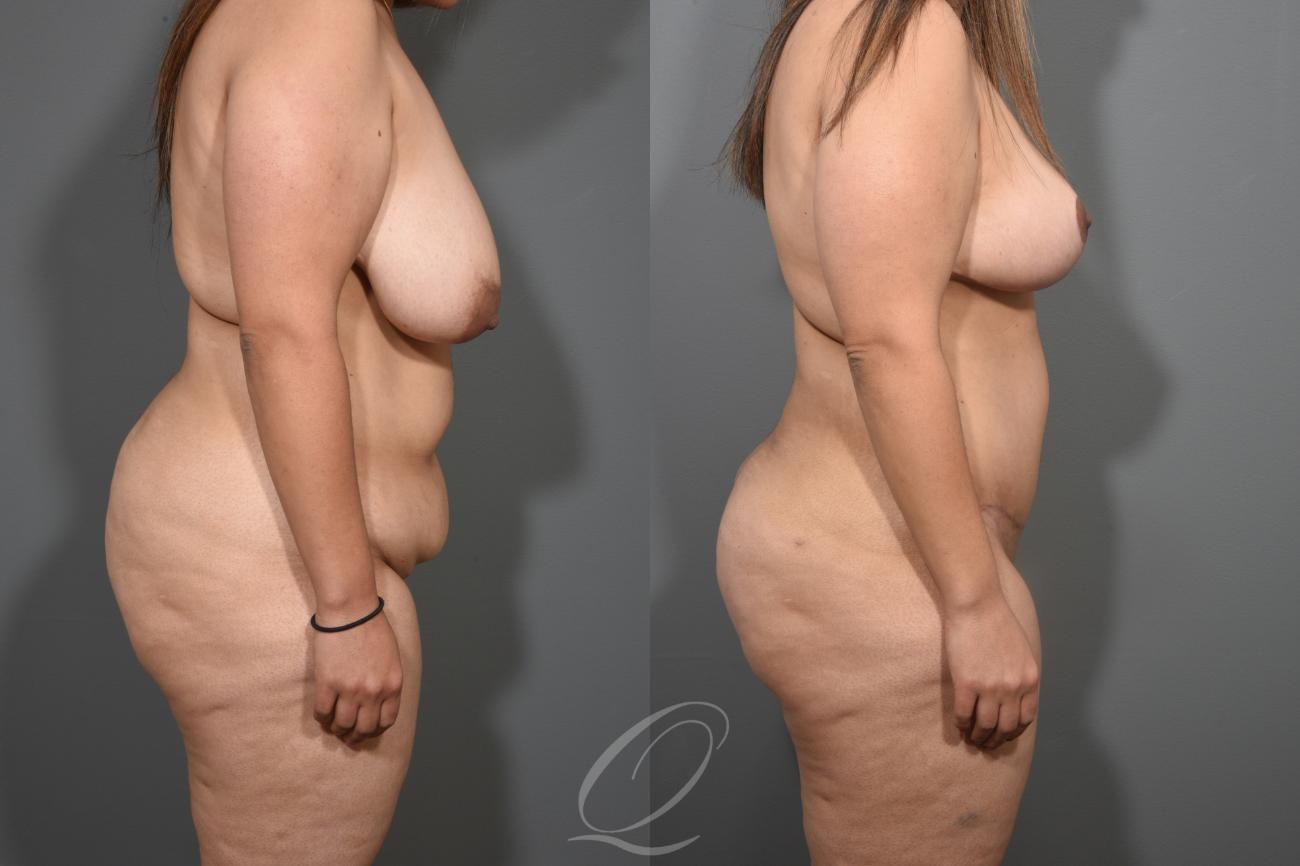 Breast Lift Case 1001259 Before & After View #3 | Serving Rochester, Syracuse & Buffalo, NY | Quatela Center for Plastic Surgery