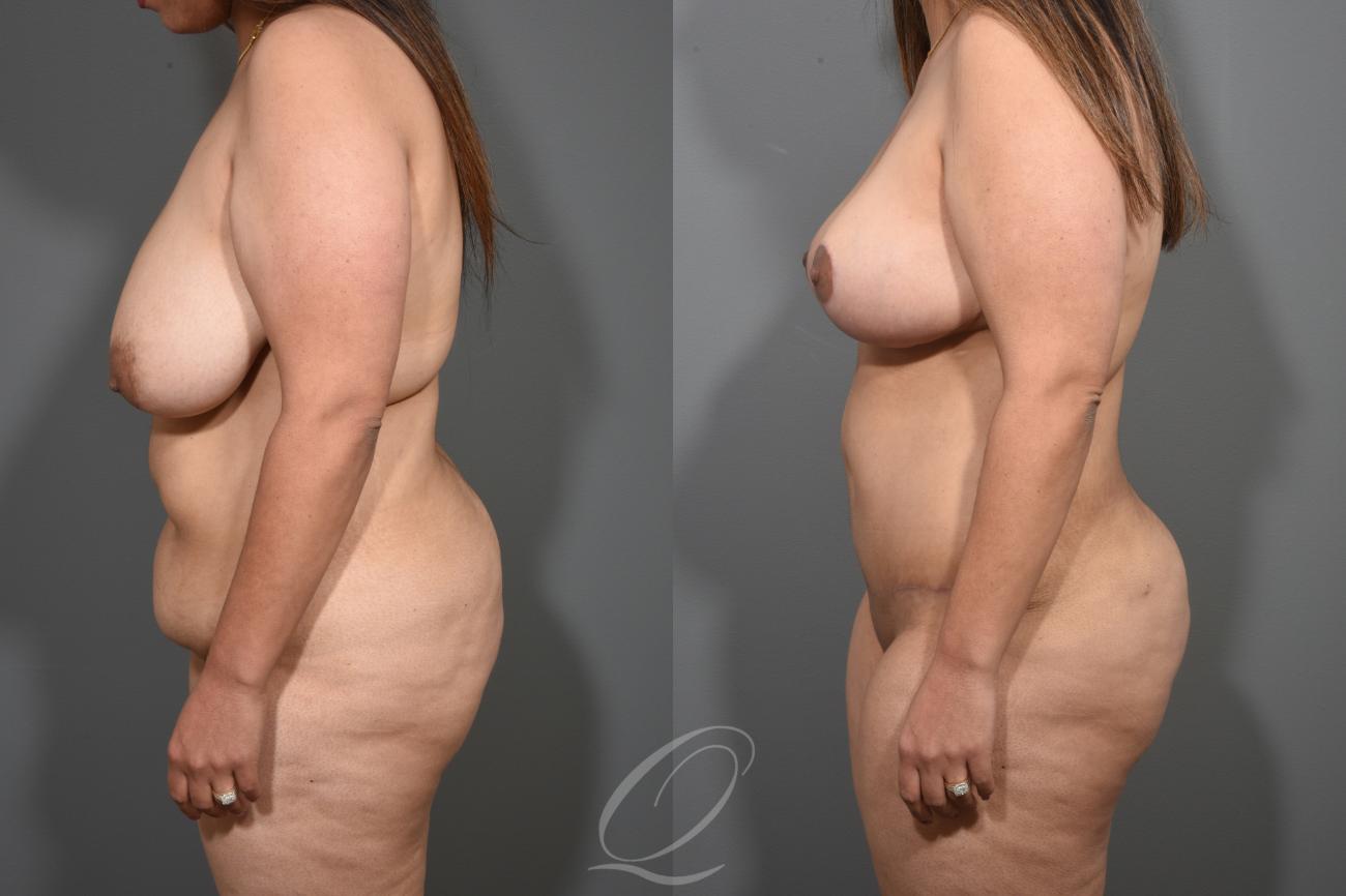 Breast Lift Case 1001259 Before & After View #5 | Serving Rochester, Syracuse & Buffalo, NY | Quatela Center for Plastic Surgery