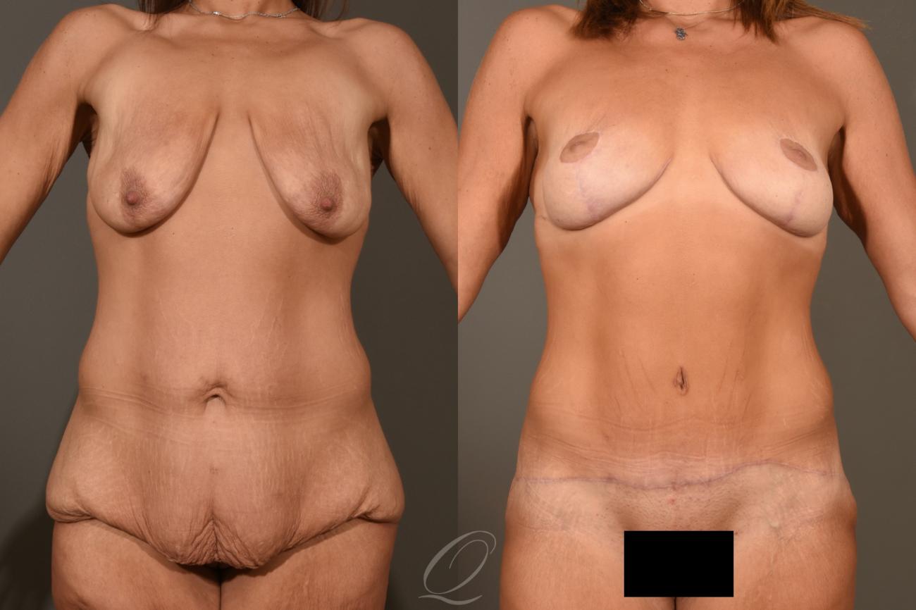 Breast Lift Case 1001299 Before & After View #1 | Serving Rochester, Syracuse & Buffalo, NY | Quatela Center for Plastic Surgery