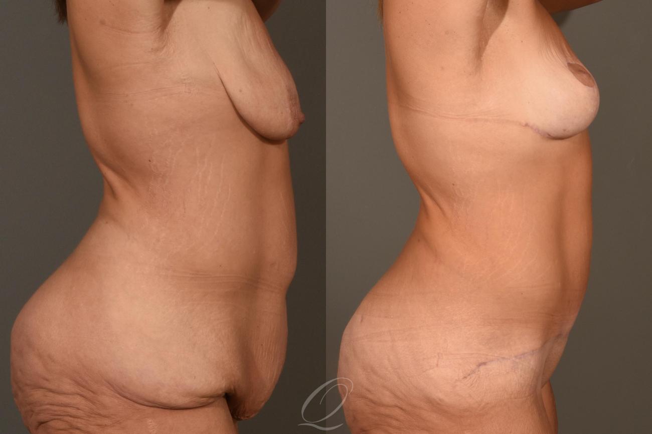Breast Lift Case 1001299 Before & After View #3 | Serving Rochester, Syracuse & Buffalo, NY | Quatela Center for Plastic Surgery