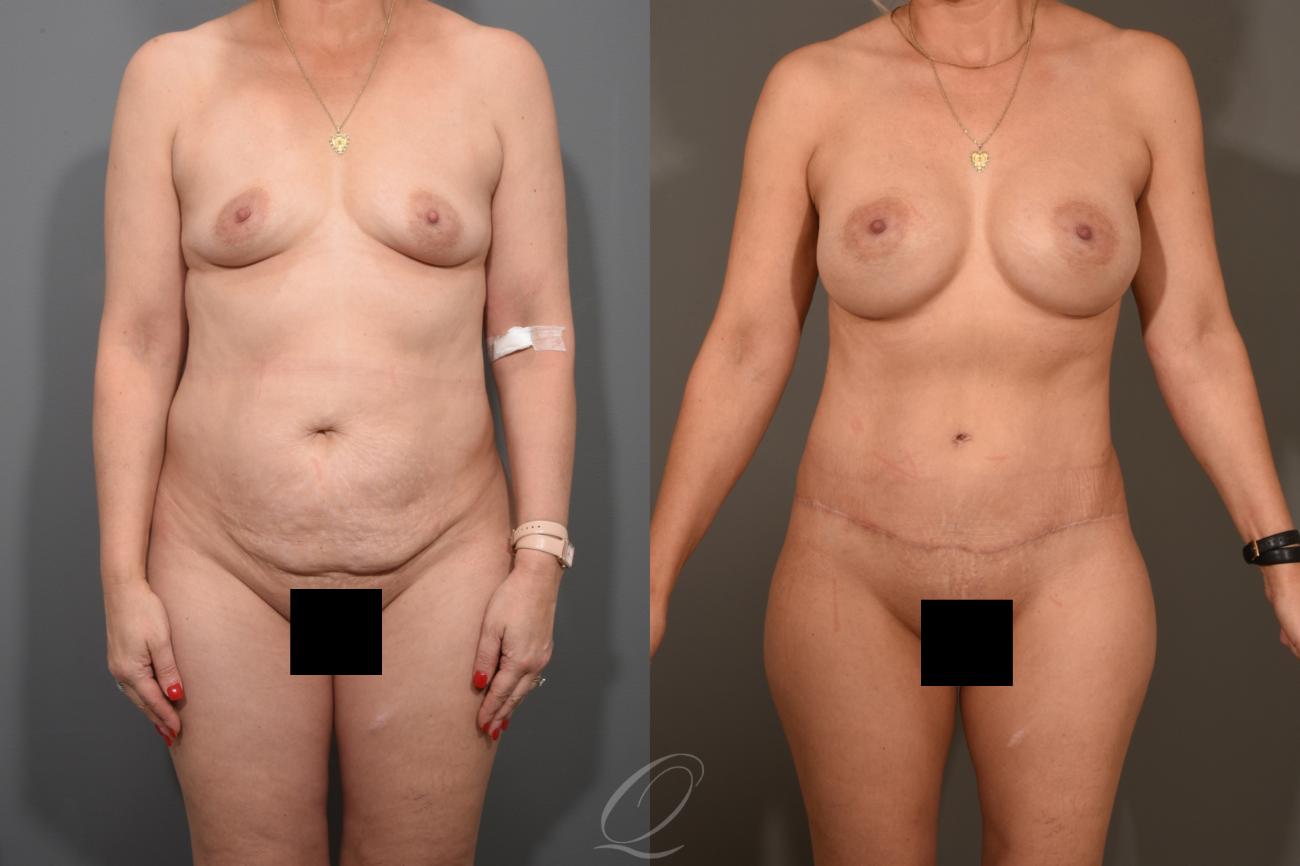 Tummy Tuck Case 381 Before & After View #1 | Serving Rochester, Syracuse & Buffalo, NY | Quatela Center for Plastic Surgery