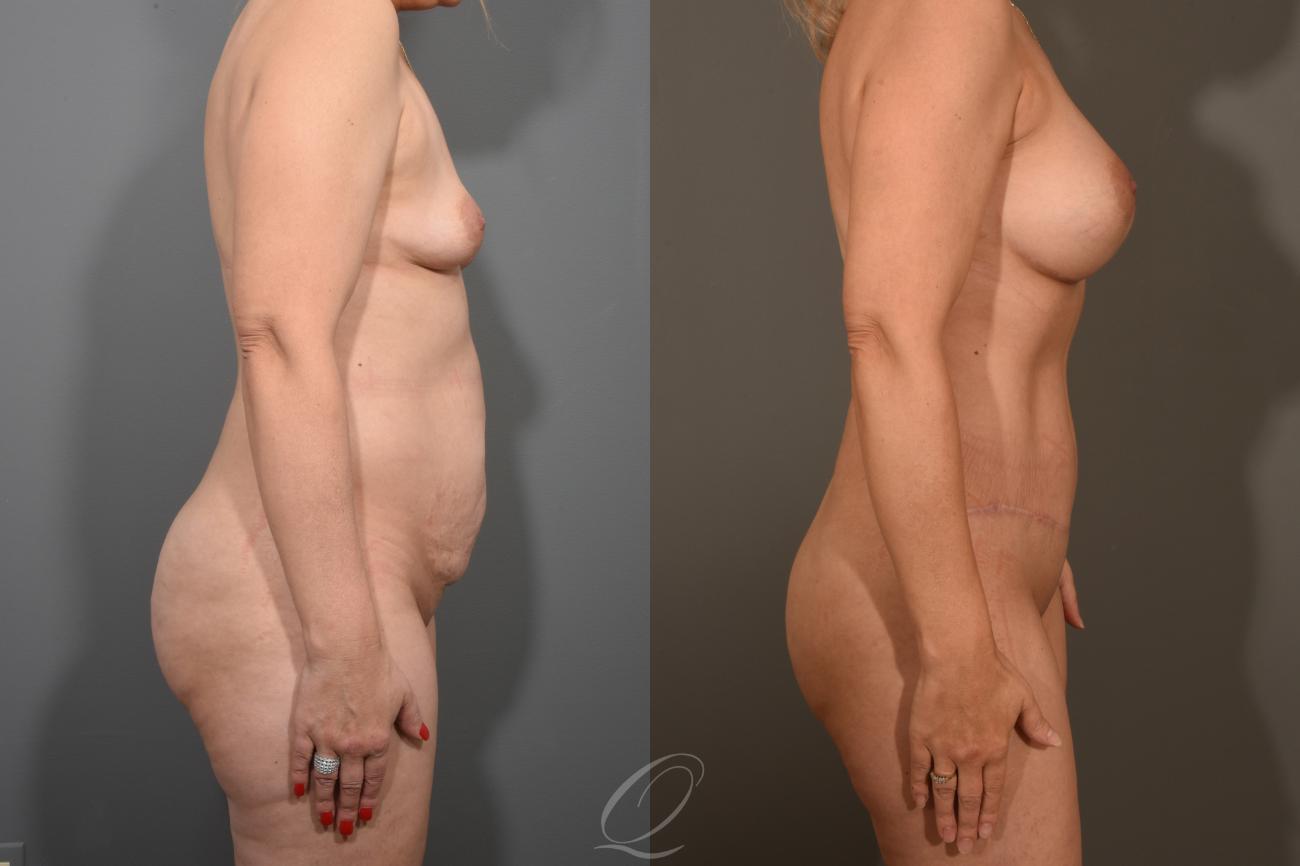 Mommy Makeover Case 381 Before & After View #3 | Serving Rochester, Syracuse & Buffalo, NY | Quatela Center for Plastic Surgery