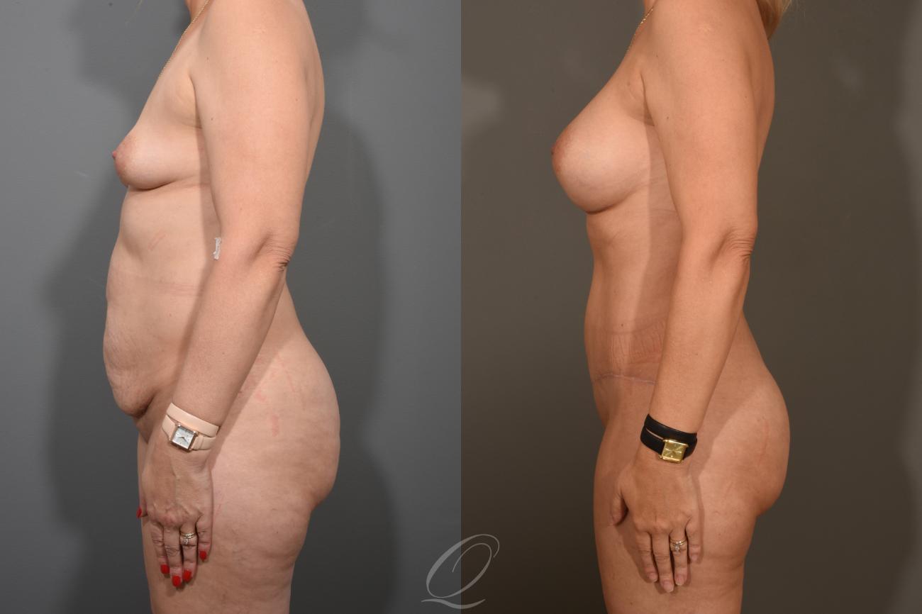 Mommy Makeover Case 381 Before & After View #5 | Serving Rochester, Syracuse & Buffalo, NY | Quatela Center for Plastic Surgery