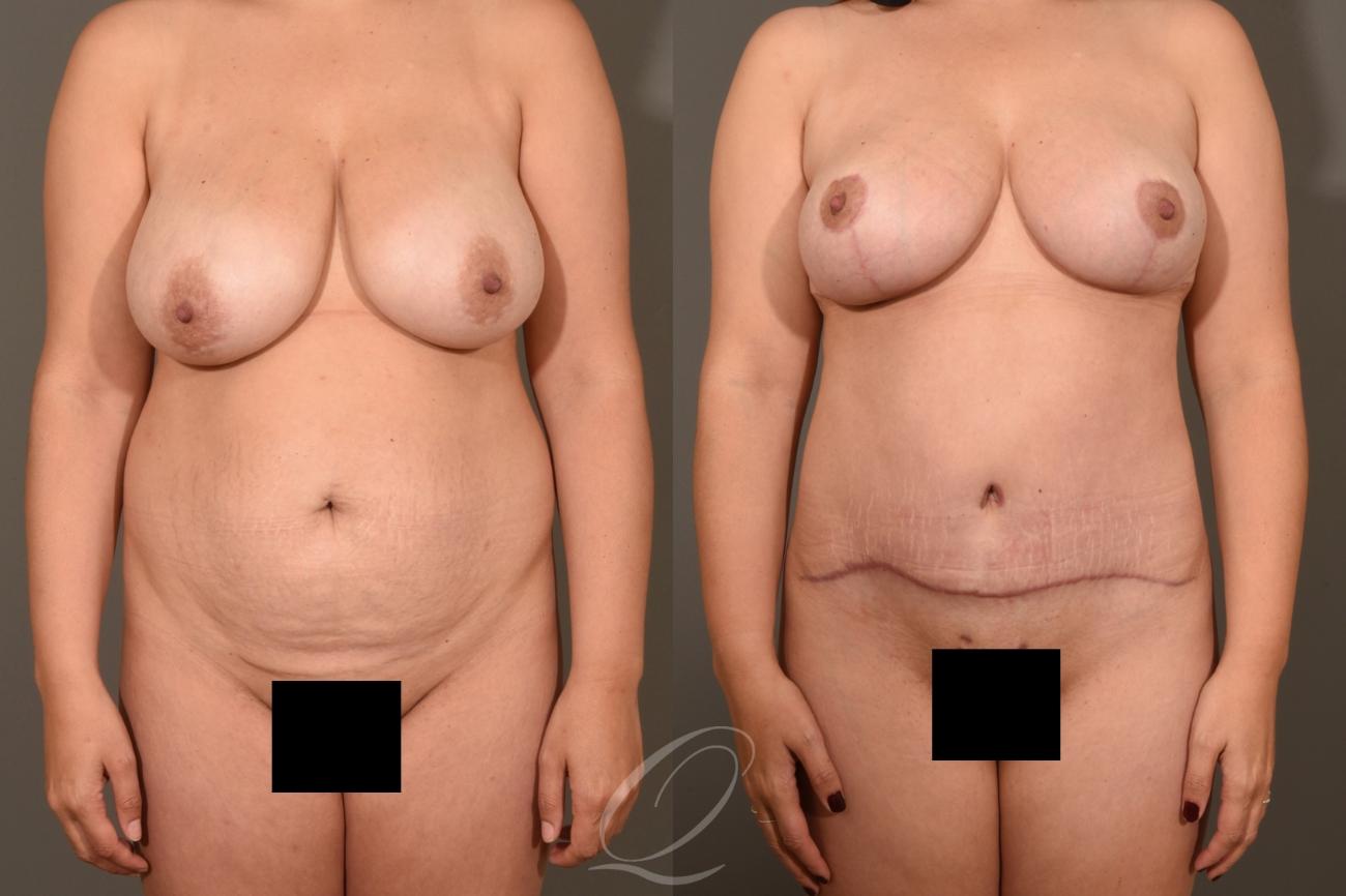 Breast Lift Case 1001324 Before & After Front | Serving Rochester, Syracuse & Buffalo, NY | Quatela Center for Plastic Surgery