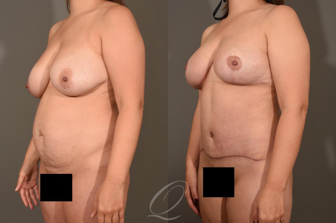 Breast Lift Case 1001324 Before & After Left Oblique | Serving Rochester, Syracuse & Buffalo, NY | Quatela Center for Plastic Surgery