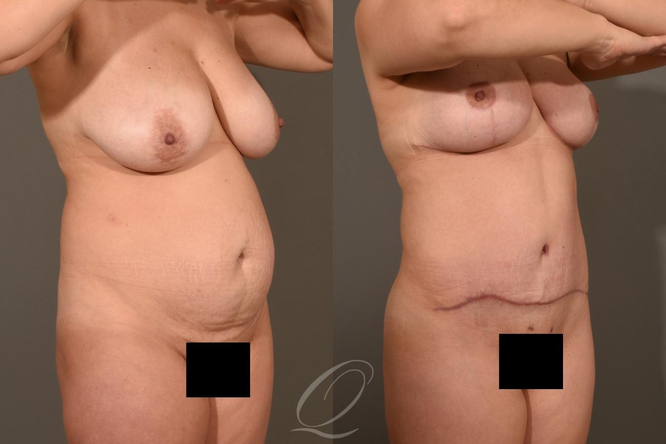 Breast Lift Case 1001324 Before & After Right Oblique | Serving Rochester, Syracuse & Buffalo, NY | Quatela Center for Plastic Surgery